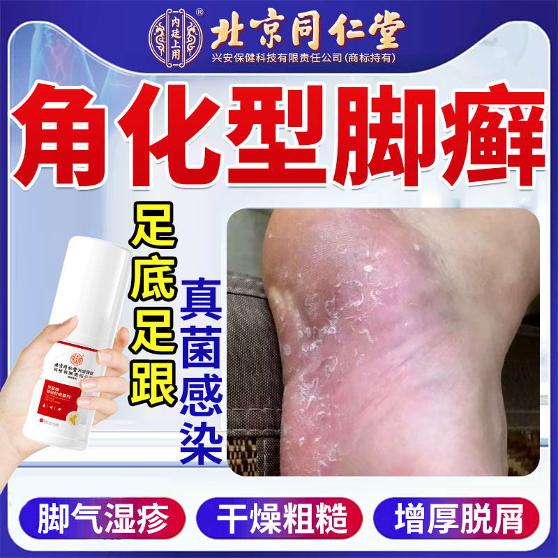 角化型脚癣脚气喷剂脚后跟干裂起硬皮足跟开裂止痒脱皮真菌感染SK