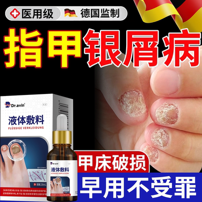 银屑病甲指甲真菌感染专外用甲银屑病凹凸不平修复液药监备案VP
