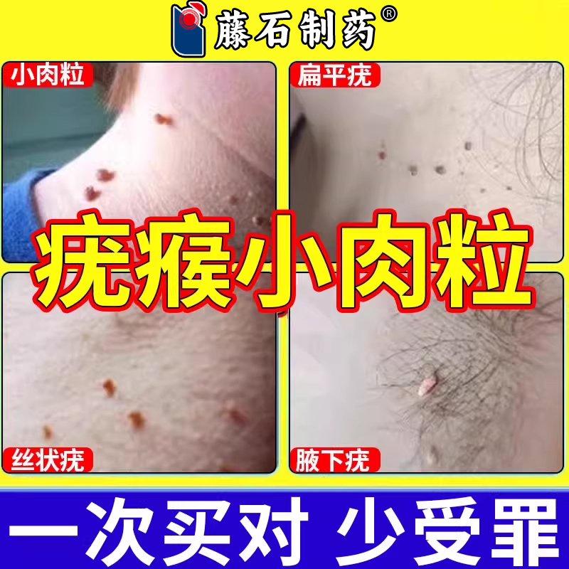 扁平疣瘊子去膏颈部脖子上长小肉粒疙瘩除腋下丝状疣肉球CA