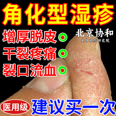 医用手癣角化型湿疹膏真菌感染