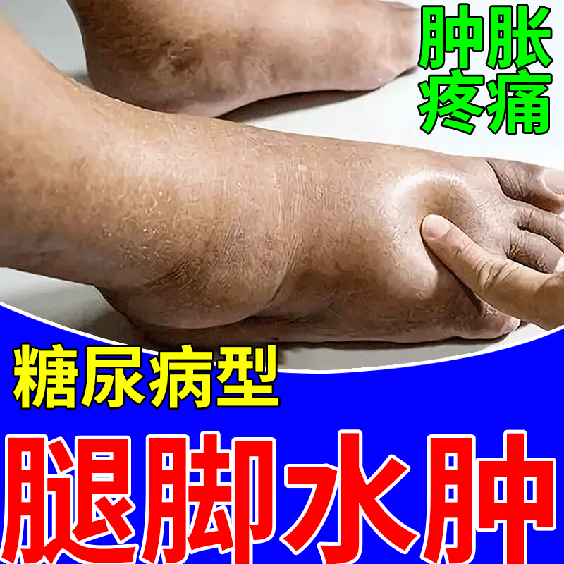 老人糖尿病脚肿消肿下肢水肿小腿浮肿胀脚背水肿胀痛可搭膏药贴vm