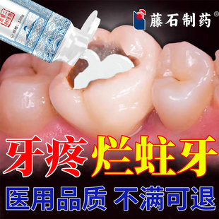 再生硅牙齿防龋凝胶防蛀抗敏含氟成人蛀牙专用牙洞清理牙虫烂牙SK