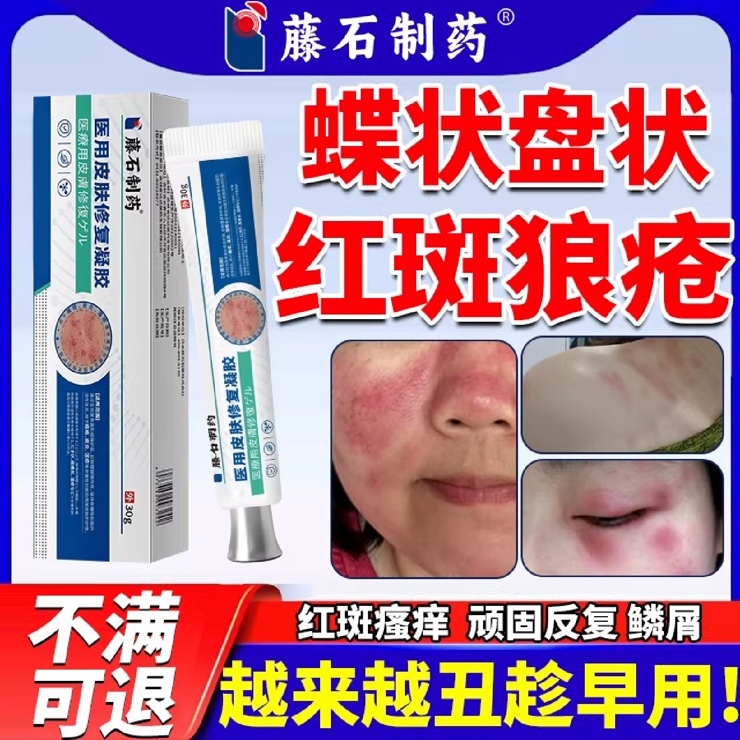 慢性盘状蝶状红斑狼疮治系统离心性红斑外用软膏皮肤疙瘩痒神器SK