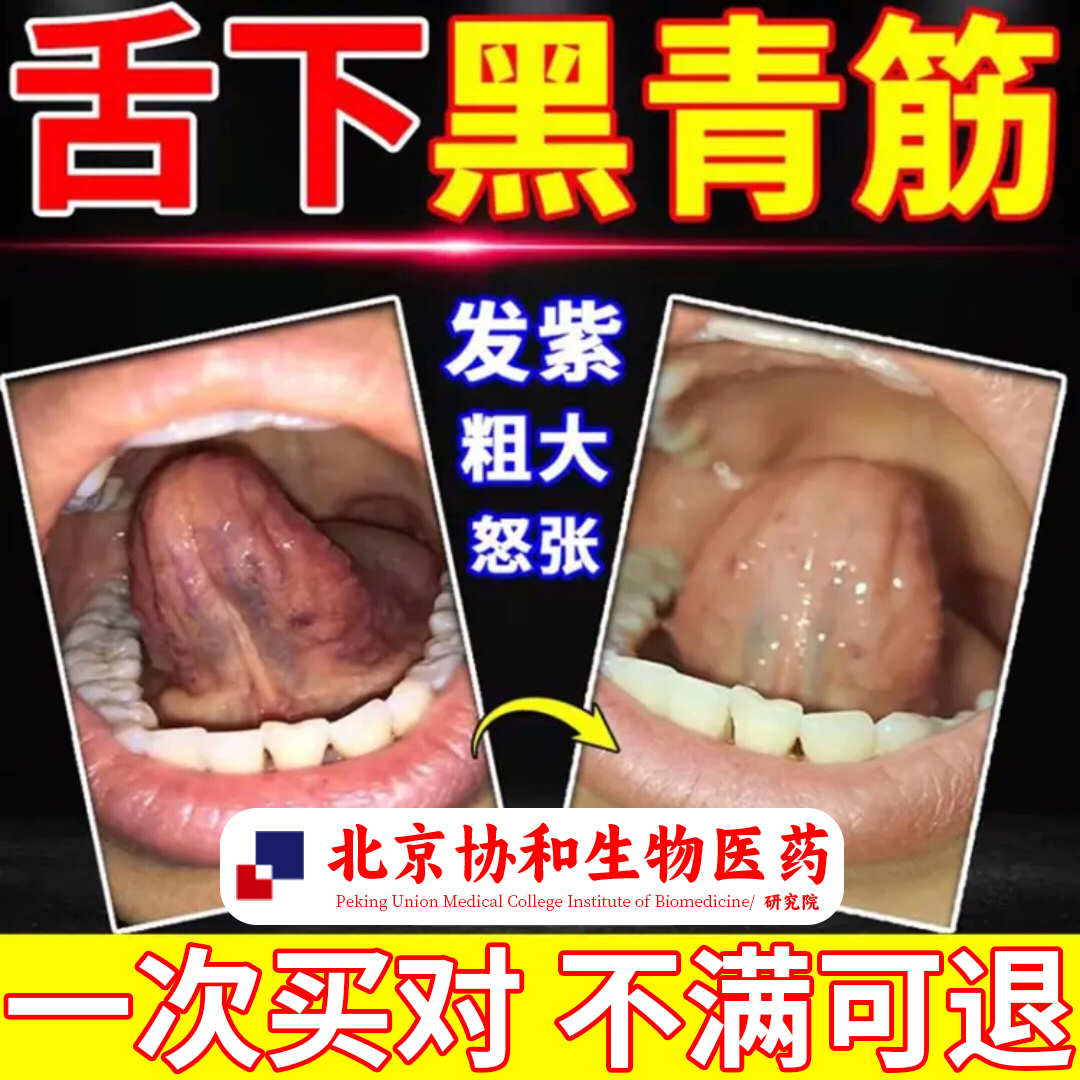 舌下青筋又黑又粗淤血疏通喷剂雾舌底严重冷黑紫粗大舌头血管ef