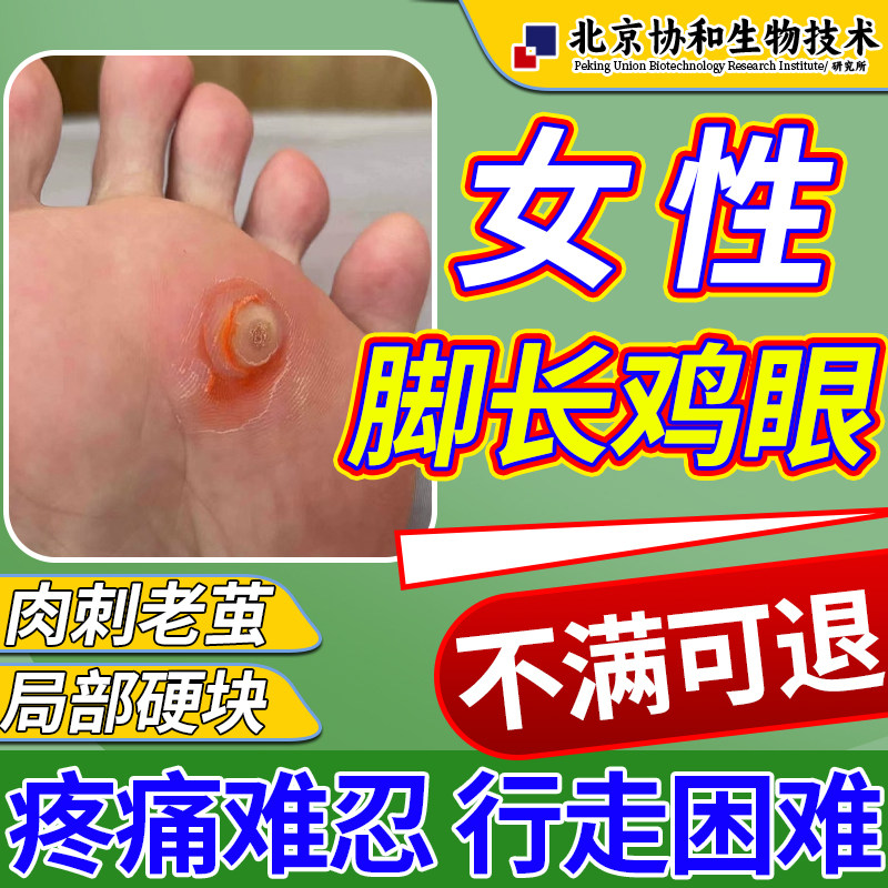 脚底长肉刺鸡眼膏鸡眼贴去除扁平疣跖疣瘊子疣老茧肉刺脚底祛除o5