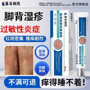 脚背上湿疹过敏性皮炎止瘙痒去脚气红斑丘疹干燥真菌感染水疱膏TZ