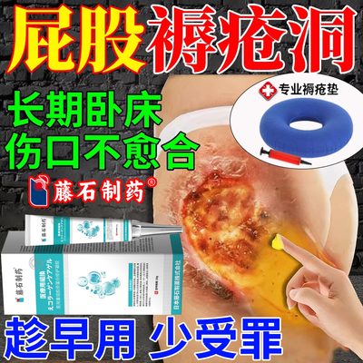 褥疮膏卧床瘫痪老人伤口愈合去腐生肌臀部外用促进长肉褥疮修复CA