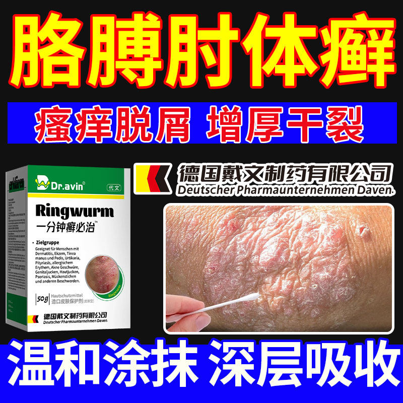 手肘癣胳膊肘癣止痒去角质起皮脱皮顽固性皮癣神经性皮炎外用膏ca
