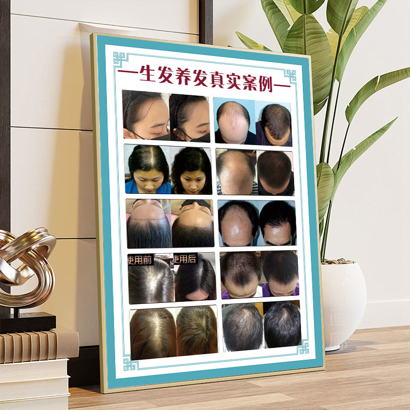 生发海报头发对比图护理广告植发图片养发馆装饰画头皮保养宣传画