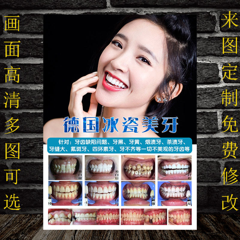 美牙图片海报贴面宣传画冰瓷美牙对比图广告纳米美牙宣传图装饰画