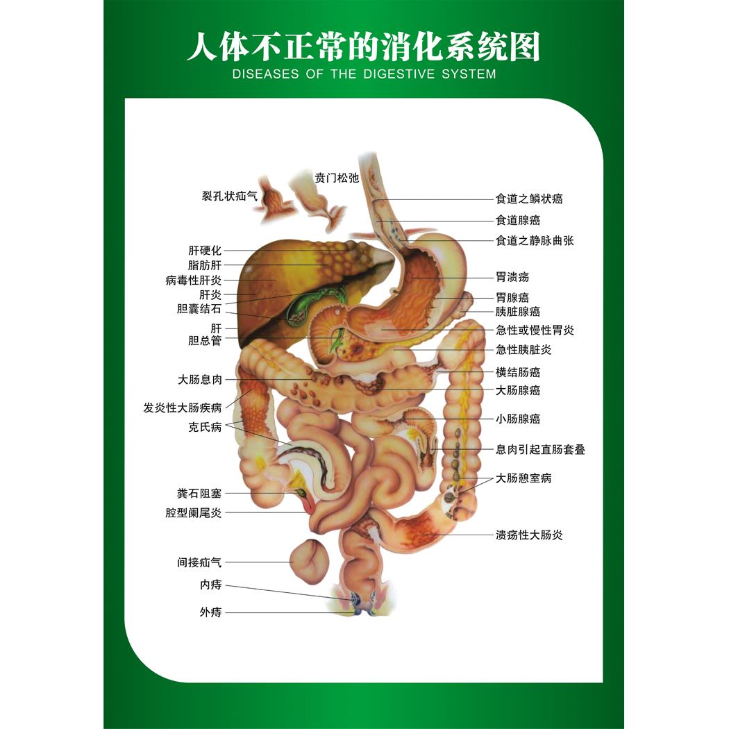 人体不正常的消化系统示意图内脏分部图人体解剖图医院宣传挂图