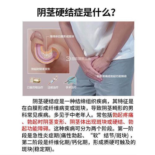 阴茎海绵体龟头硬结节症硬化性男性淋巴管炎弯曲修药房同款复膏BS
