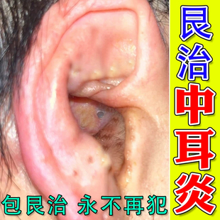 耳朵止痒液痒外耳道中耳霉菌真菌感染抑菌喷剂炎水杨酸酒精滴耳液