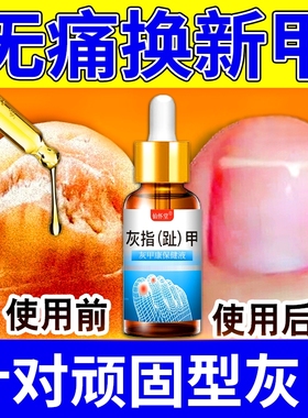 灰指甲抑菌液亮甲专用脱甲膏正品官方旗舰店凤仙花修脚刀真菌感染