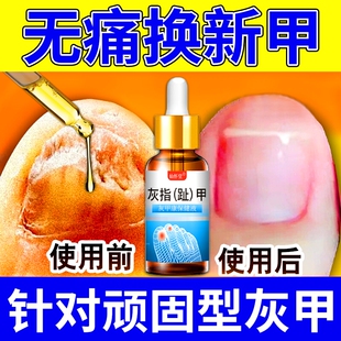 灰指甲抑菌液亮甲专用脱甲膏正品 官方旗舰店凤仙花修脚刀真菌感染