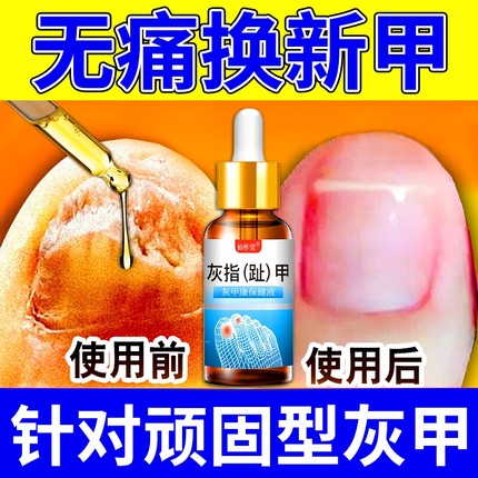 灰指甲抑菌液亮甲专用脱甲膏正品官方旗舰店凤仙花修脚刀真菌感染