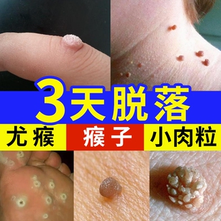 去除尤疣瘊猴子祛除扁平神器脖子上长小肉粒疙瘩一抹无忧灵药膏