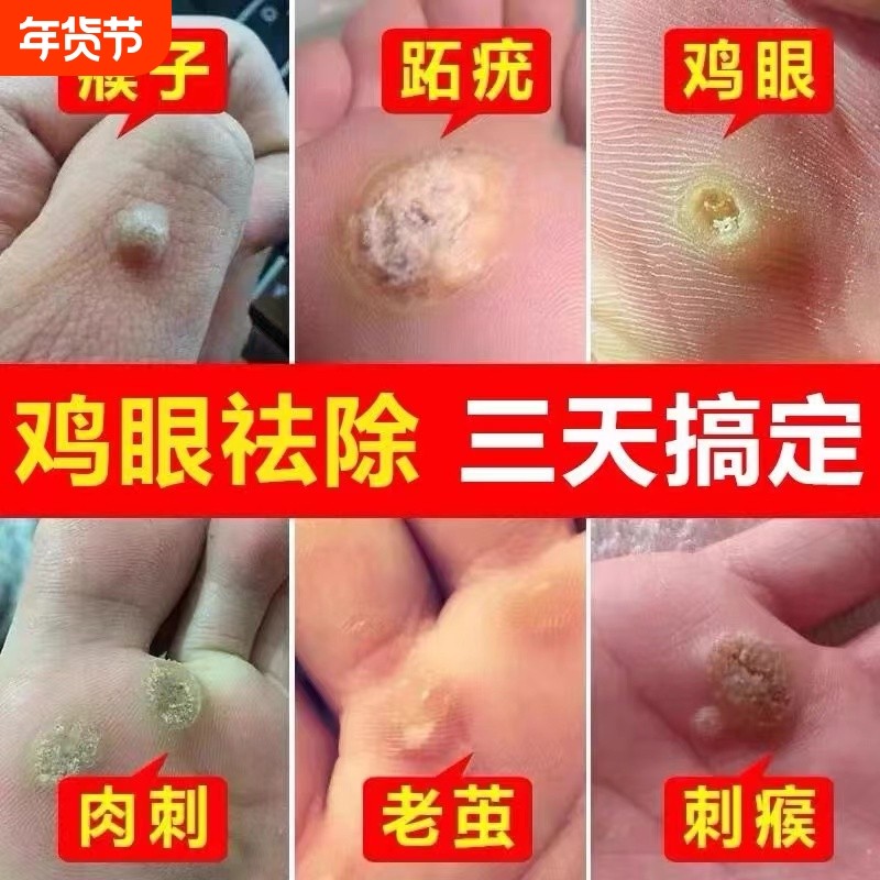 云南本草鸡眼贴鸡眼膏鸡贴眼正品去脚底鸡眼药膏去除液老茧草本