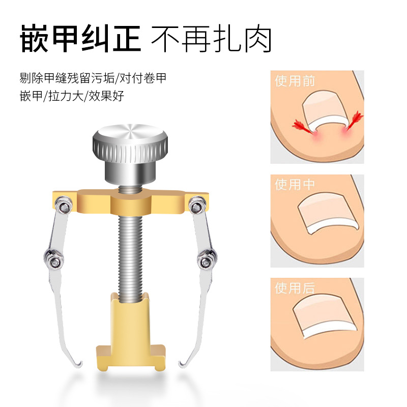 指甲矫正器甲沟炎嵌甲神器垫片剔甲器脚趾甲长到肉里贴片修脚护理