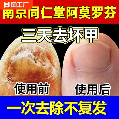 阿莫罗芬搽剂灰指甲治療专用正品旗舰店修复脱甲膏真菌感染抑菌液