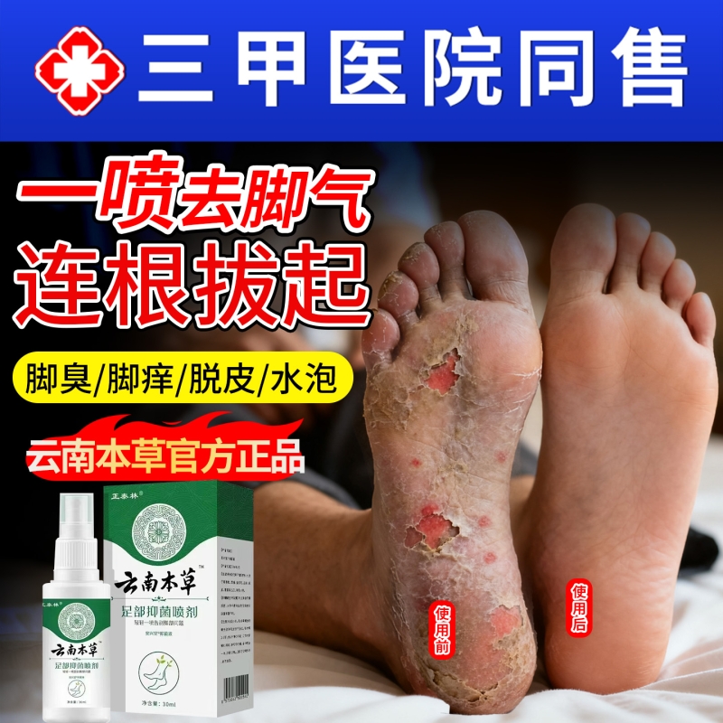 脚气喷雾止脱皮痒杀菌去真菌感染专用特根糜烂脚丫脚趾缝除臭出汗