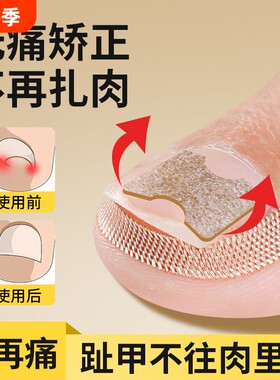 甲沟嵌甲矫正器甲沟脚指甲修正器炎内嵌脚趾甲勾盖长肉里纠正神器