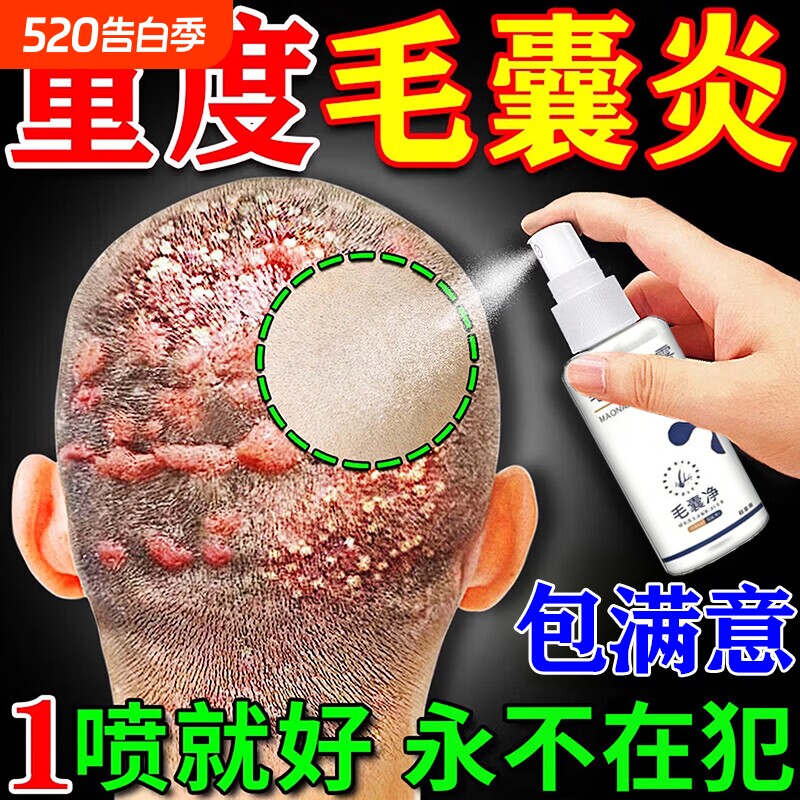 头皮毛囊炎喷雾剂头皮痒有疙瘩马拉色真菌头部硬专用皮肤消毒周围