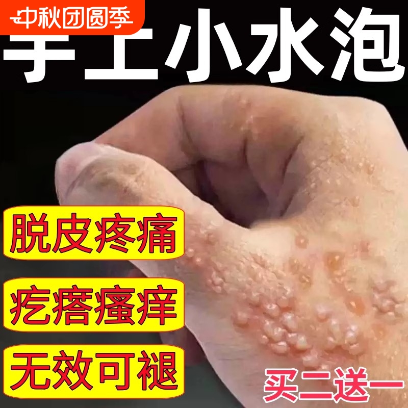 手上起小水泡水泡状脱皮真菌感染发红发痒痒瘙痒外用手指手背抑菌