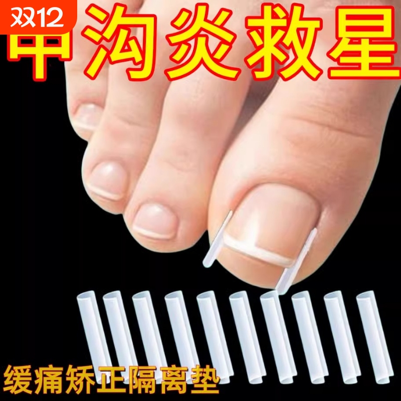 甲沟炎矫正器嵌甲|超2.1万次加购