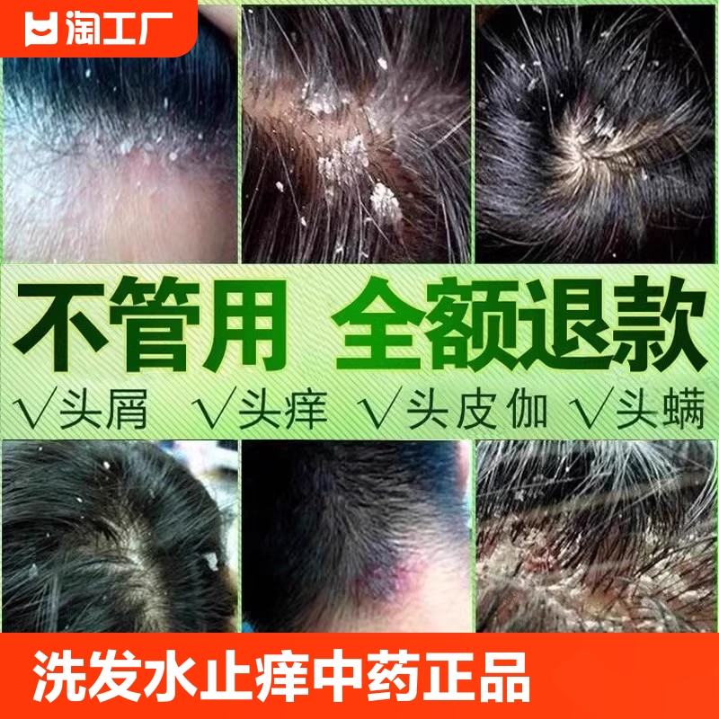 洗发水去屑止痒中药正品去头屑洗头膏严重头皮屑癣官方品牌旗舰店