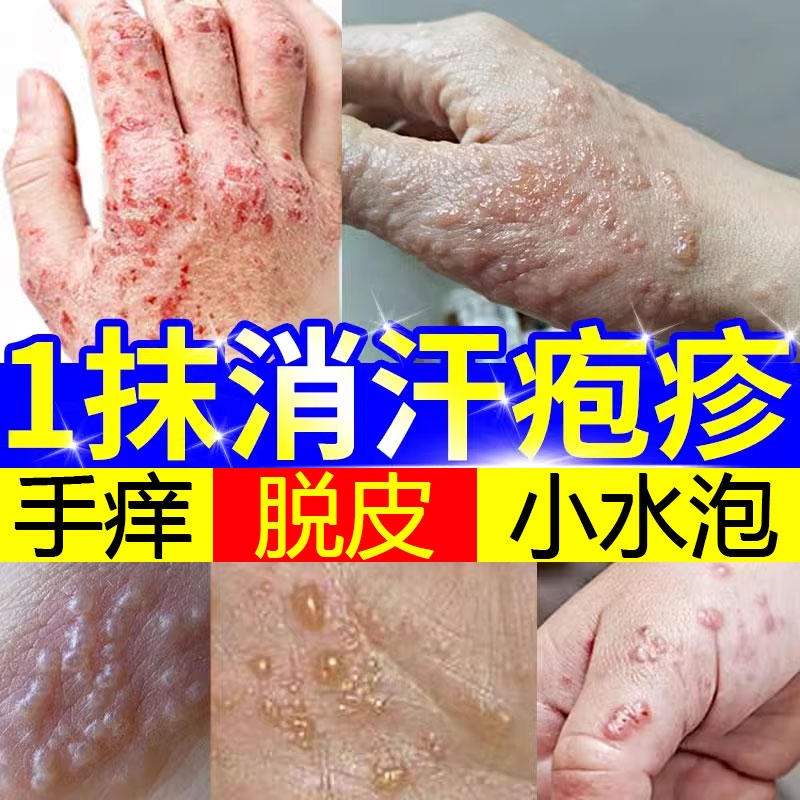 云南本草汗孢疹膏汗包膏泡疱疹手上小水泡脱皮痒汗状疱疹专用软膏