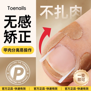 甲沟神器指甲矫正器嵌甲专用拉贴隔离脚趾甲长肉里填充垫片纠正炎