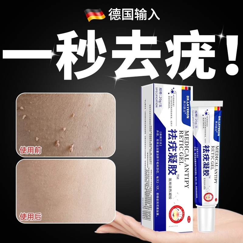 去疣瘊小肉粒一抹灵无忧去除扁平疣丝状疣瘊子软膏药脖子猴子神器