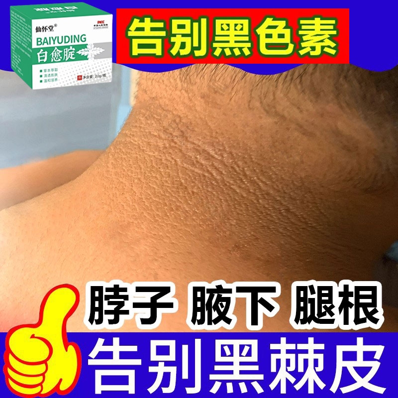 脖子黑色素去除黑棘皮症沉淀洗不干净颈部皮肤美白神器腋下