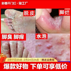 脚痒水泡脱皮烂脚丫根脚气止痒杀菌喷雾专用去脚趾缝烂痒臭膏抑菌