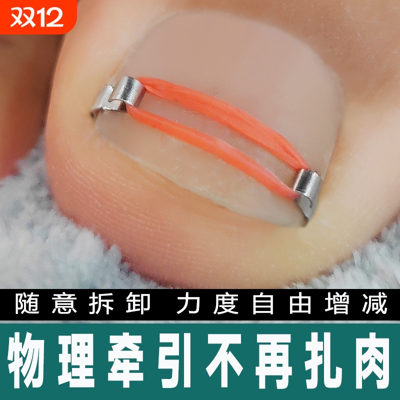 今日特价嵌甲矫正器用创