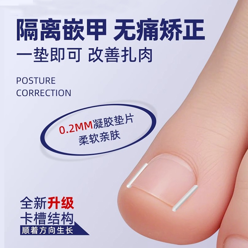 甲沟矫正器炎嵌甲神器纠正指甲扎肉大脚趾甲往肉里长隔离填充垫片