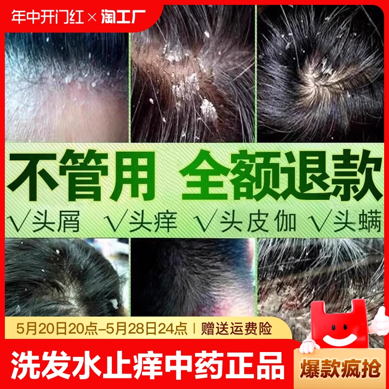 洗发水去屑止痒中药正品去头屑洗头膏严重头皮屑癣官方品牌旗舰店