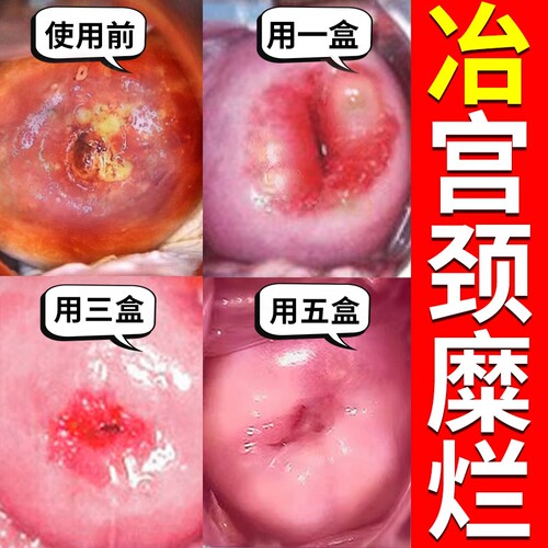 同仁堂专用消糜栓|103人收藏