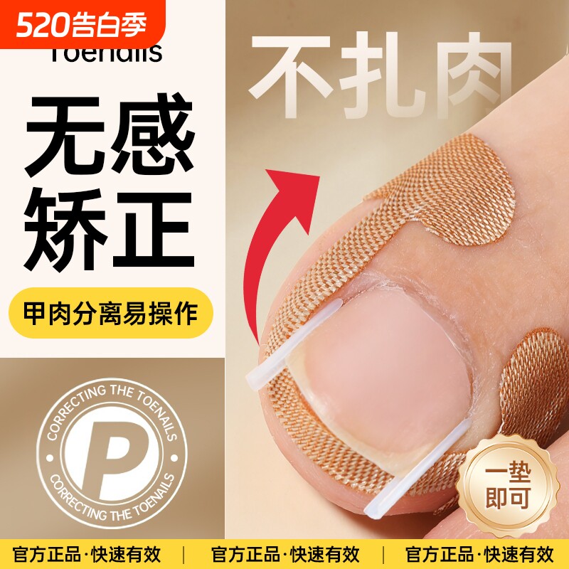 甲沟神器指甲矫正器嵌甲专用拉贴隔离脚趾甲长肉里填充垫片纠正炎