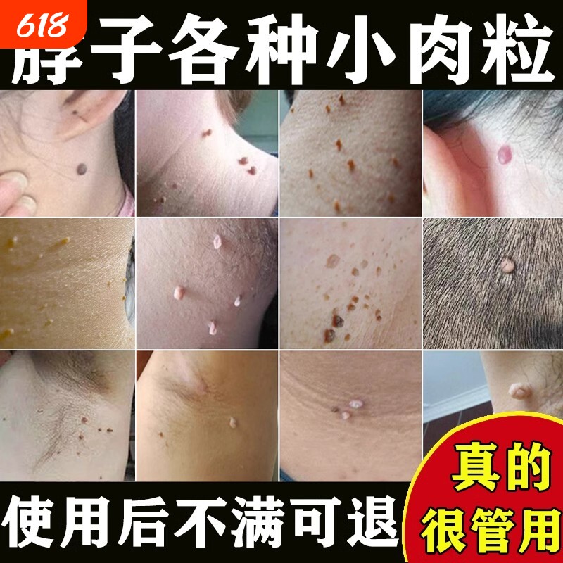 云南本草去脖子上小肉球肉粒肉刺疙瘩去除神器腋下抑菌草本植物