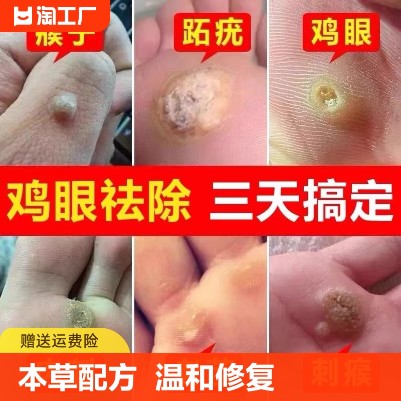 云南本草鸡眼贴鸡眼膏鸡贴眼正品去脚底鸡眼药膏去除液老茧草本