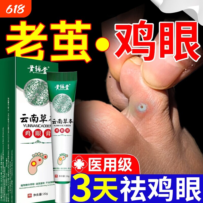 云南草本鸡眼膏官方正品旗舰店鸡茧子鸡眼脚部脚底老茧20g医用级