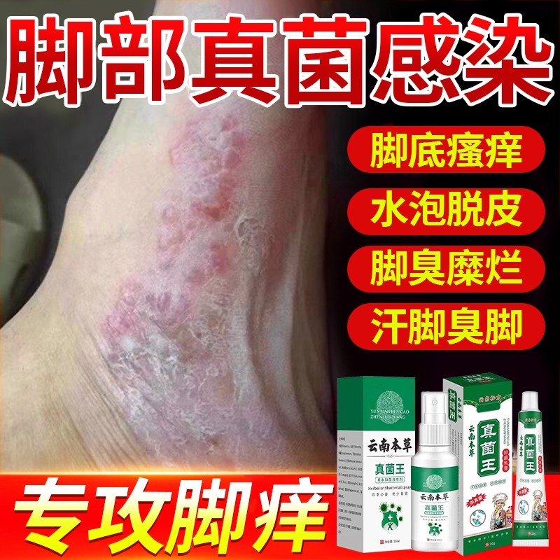 脚喷雾止痒脱皮杀菌真菌感染专用脚痒水泡烂脚丫效药特药膏