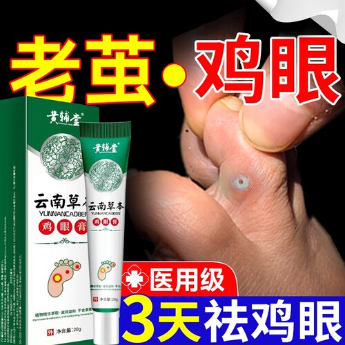 云南草本鸡眼膏官方正品旗舰店鸡鸡眼脚底老茧20g医用级跖疣植物
