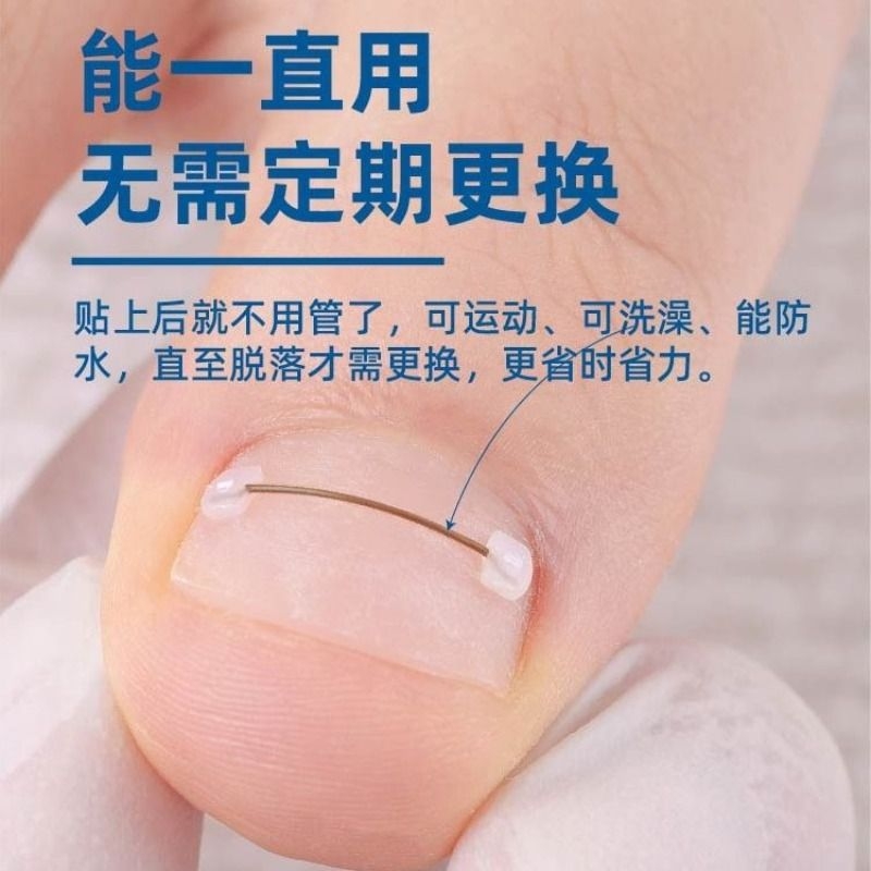 镍钛丝矫正器4根套装|195人好评
