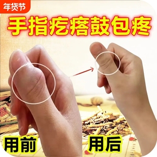 手指骨节粗大变形关节疙瘩鼓包肿大消肿疼痛专用活络
