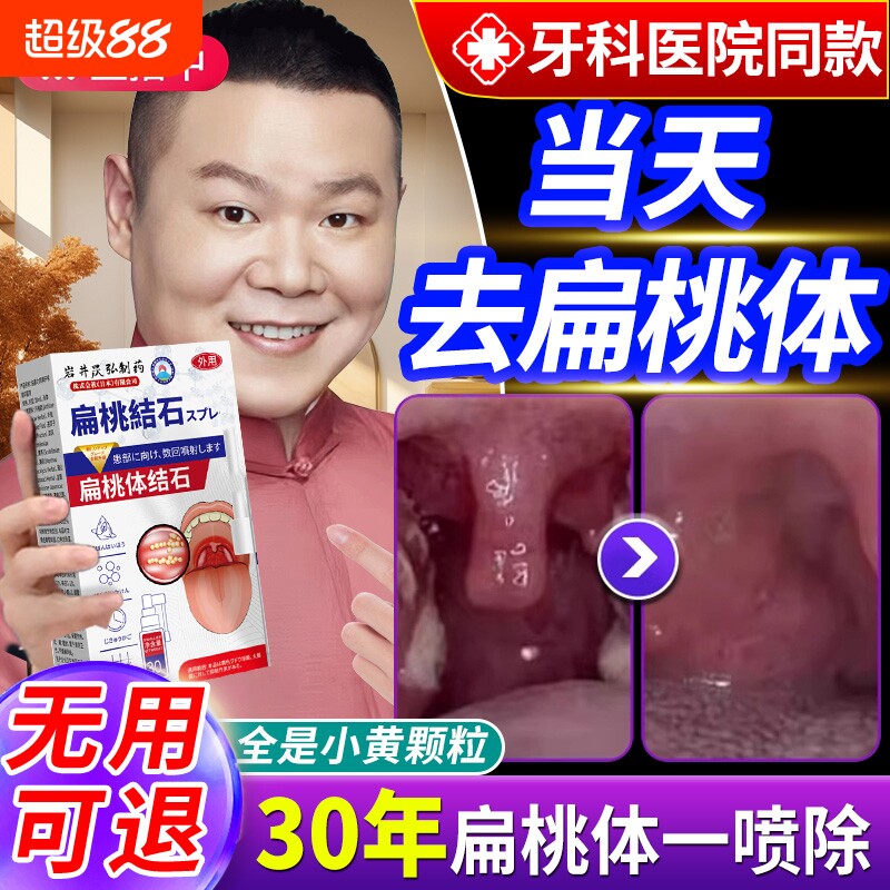 口臭扁桃体结石去除工具漱口水喷剂清理神器口腔清洗器隐窝冲洗器