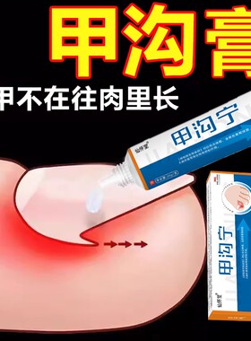 脚趾甲沟炎矫正器息肉软化剂药膏灰指甲脱甲膏凤仙花抑菌液脱甲液