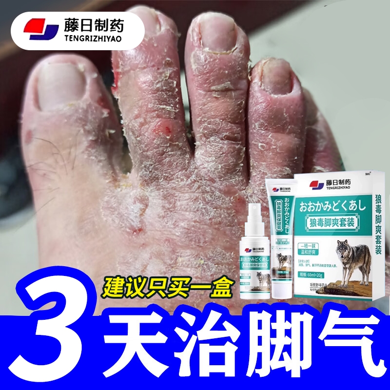 【胖東来断货推荐】狼毒脚气套装